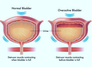 overactive bladder syndrome
