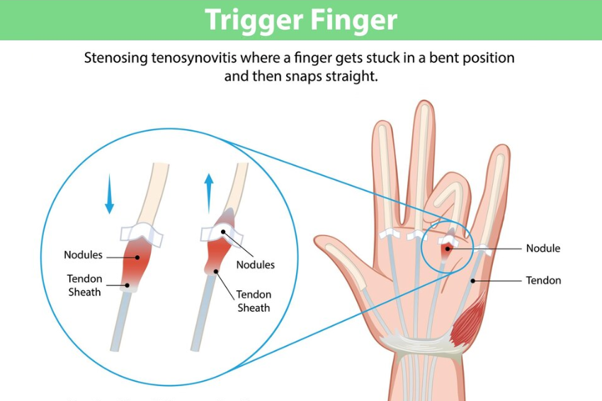 Trigger Finger Treatment: Options for Relief and Recovery